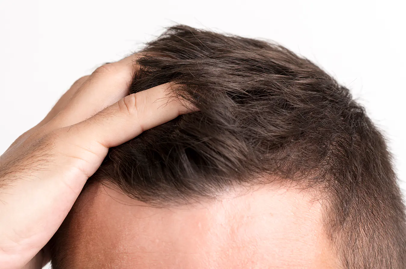 Hair Loss Product Buyers Mailing List